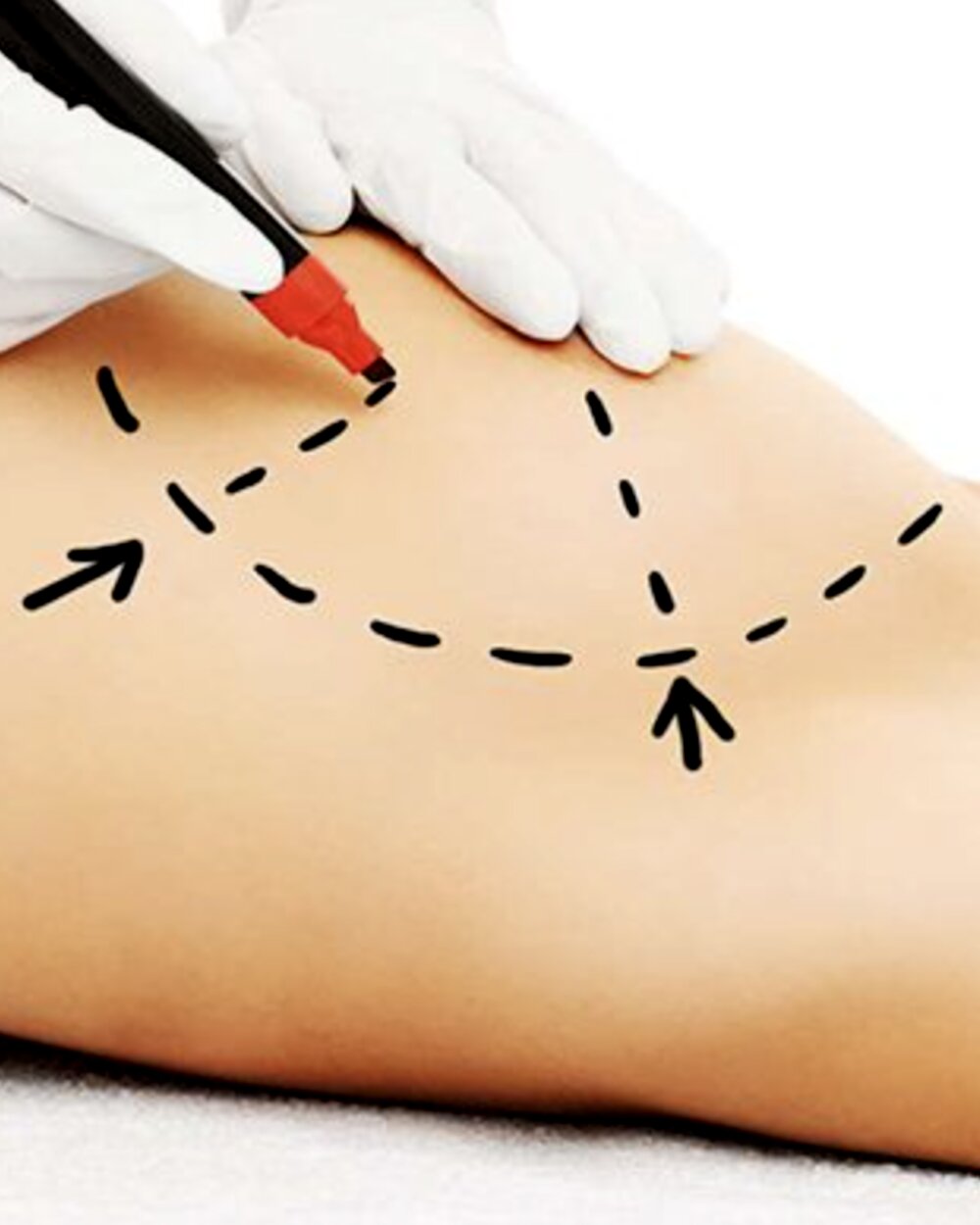 Mamoplastia